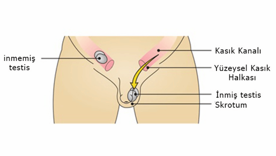 inmemiş testis çocuk